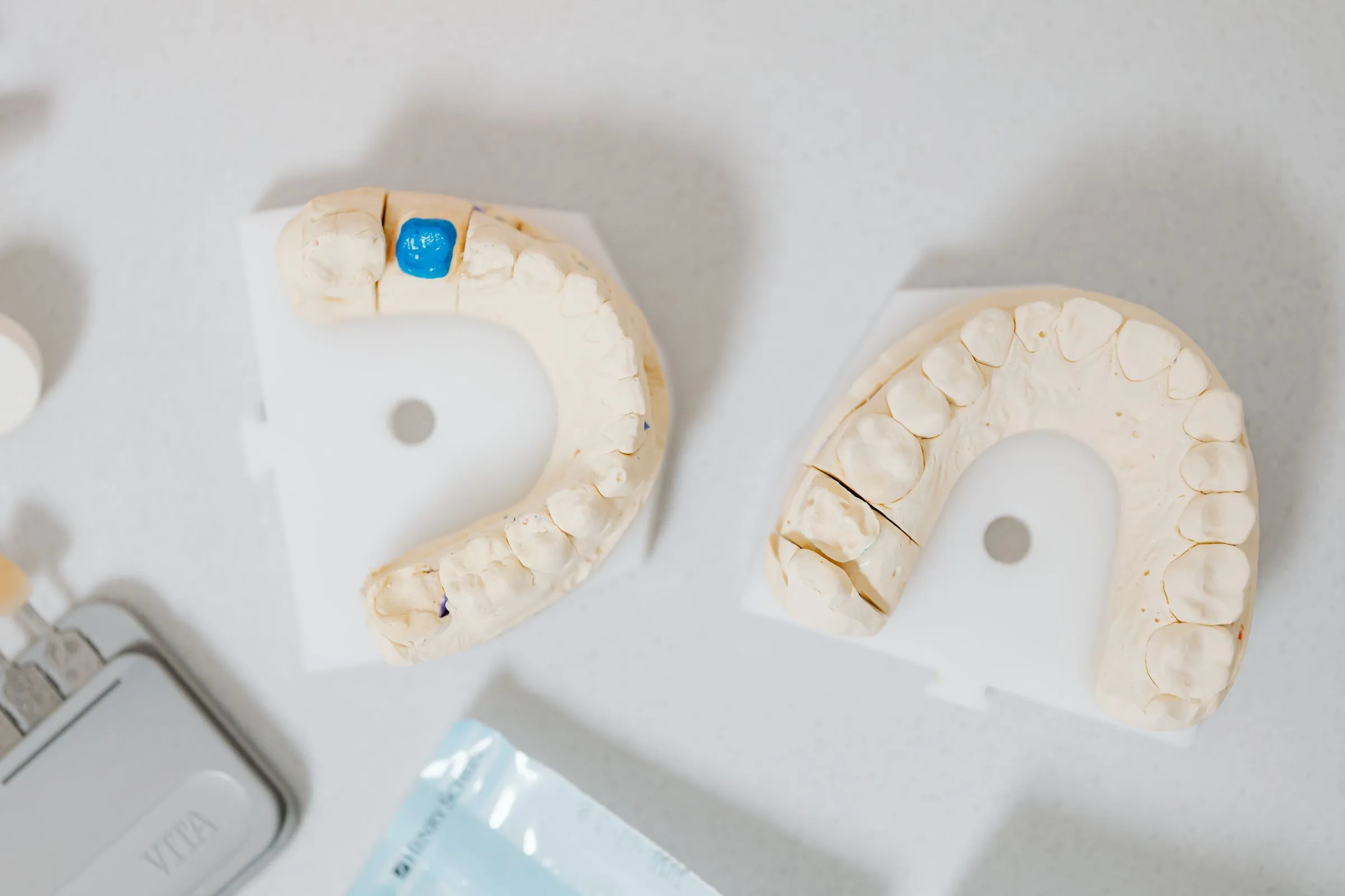 Upper and lower dental casts used to plan a fixed restoration